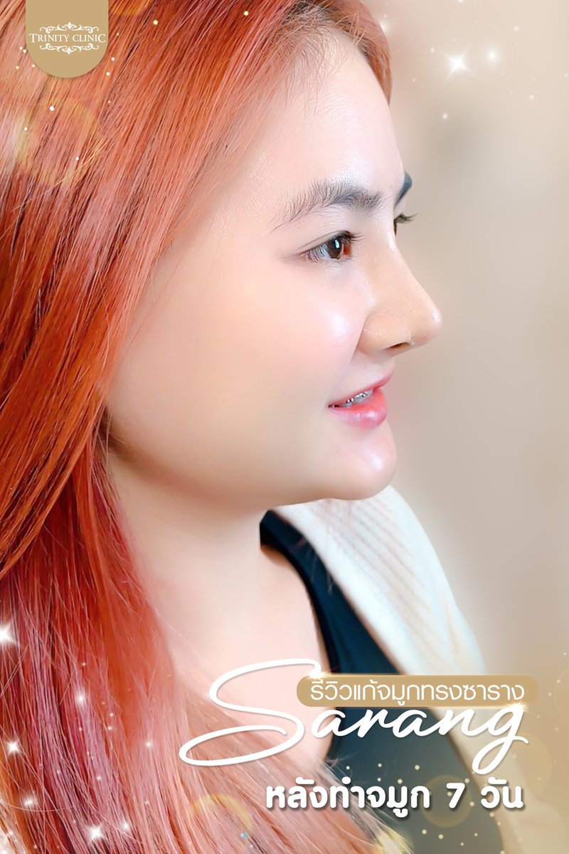trinityclinic01's tweet photo. 7 วัน ต้องสวยขนาดนี้ อิจฉาไม่ไหว จมูกสวยปังมาก
สอบถามเพิ่มเติม 095-5150547
https://t.co/ZOoqKMZwfR
#เสริมจมูก #ศัลยกรรมสวย #NTLT #ทรินิตี้คลินิก #รีวิวบิวตี้ #เน็ตไอดอล #ศัลยกรรม #รีวิวศัลยกรรม #botox #ฟิลเลอร์ #HIFU #หน้าตึง #beauty #TwitterX https://t.co/0VOoQf8DWU