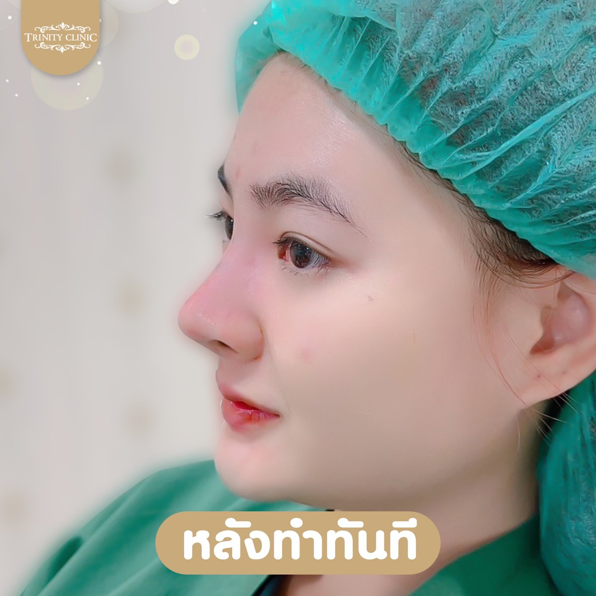 trinityclinic01's tweet photo. 7 วัน ต้องสวยขนาดนี้ อิจฉาไม่ไหว จมูกสวยปังมาก
สอบถามเพิ่มเติม 095-5150547
https://t.co/ZOoqKMZwfR
#เสริมจมูก #ศัลยกรรมสวย #NTLT #ทรินิตี้คลินิก #รีวิวบิวตี้ #เน็ตไอดอล #ศัลยกรรม #รีวิวศัลยกรรม #botox #ฟิลเลอร์ #HIFU #หน้าตึง #beauty #TwitterX https://t.co/0VOoQf8DWU
