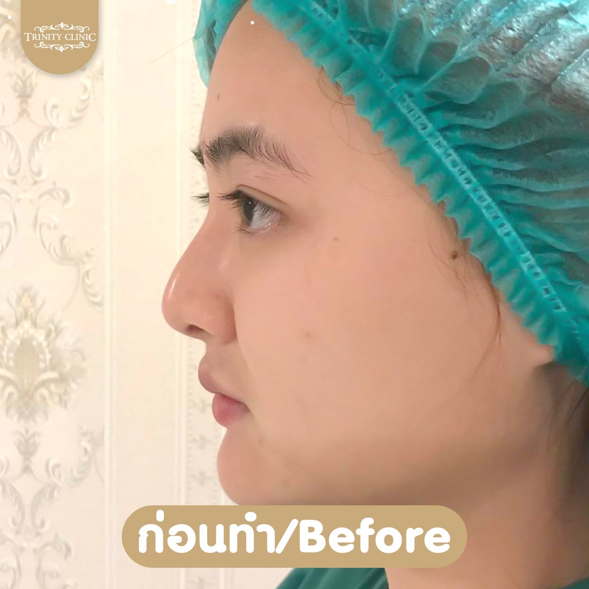 trinityclinic01's tweet photo. 7 วัน ต้องสวยขนาดนี้ อิจฉาไม่ไหว จมูกสวยปังมาก
สอบถามเพิ่มเติม 095-5150547
https://t.co/ZOoqKMZwfR
#เสริมจมูก #ศัลยกรรมสวย #NTLT #ทรินิตี้คลินิก #รีวิวบิวตี้ #เน็ตไอดอล #ศัลยกรรม #รีวิวศัลยกรรม #botox #ฟิลเลอร์ #HIFU #หน้าตึง #beauty #TwitterX https://t.co/0VOoQf8DWU