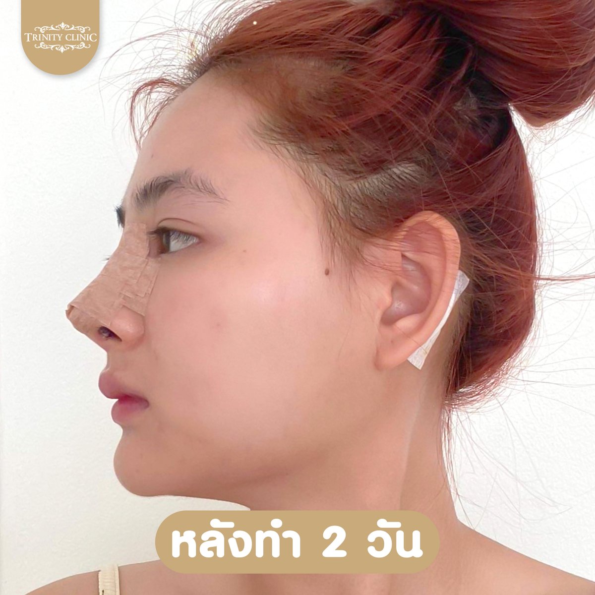 trinityclinic01's tweet photo. 7 วัน ต้องสวยขนาดนี้ อิจฉาไม่ไหว จมูกสวยปังมาก
สอบถามเพิ่มเติม 095-5150547
https://t.co/ZOoqKMZwfR
#เสริมจมูก #ศัลยกรรมสวย #NTLT #ทรินิตี้คลินิก #รีวิวบิวตี้ #เน็ตไอดอล #ศัลยกรรม #รีวิวศัลยกรรม #botox #ฟิลเลอร์ #HIFU #หน้าตึง #beauty #TwitterX https://t.co/0VOoQf8DWU