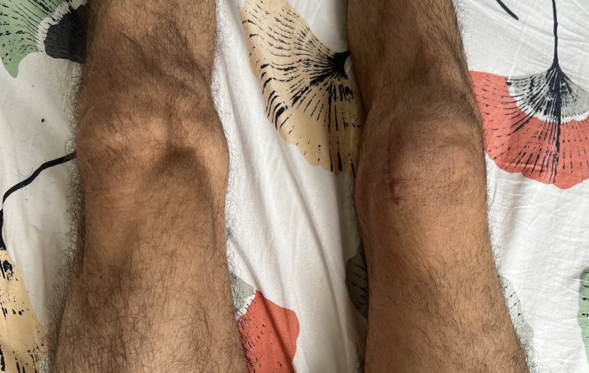 I’m going to start streaming my football (soccer) games with a head mounted GoPro to twitch

16/01/2022 I shattered my kneecap, tore my MCL and broke my tibia in game. It’s been a long and difficult journey. I swore I wouldn’t play again… I don’t have the same ability but onward