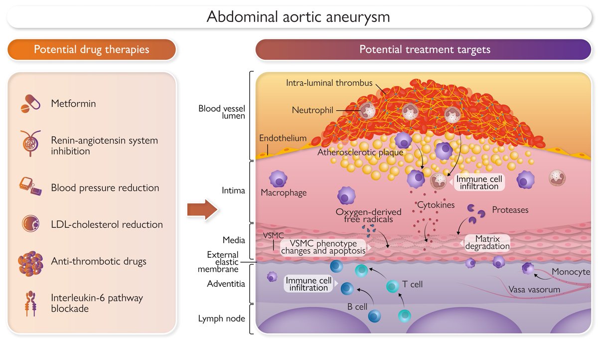 Pathogenesis and management of abdominal aortic aneurysm. A State-of-the-Art Review just published in #EHJ. academic.oup.com/eurheartj/arti… #CardioTwitter #aorticaneurysm @escardio @ESC_Journals