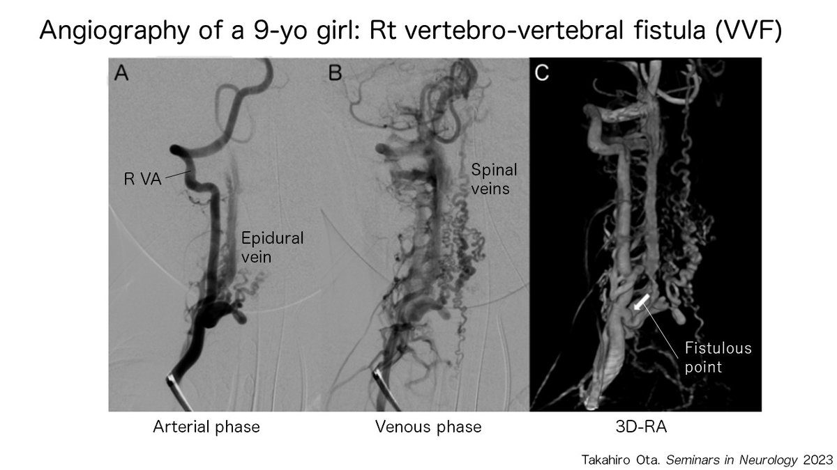 Taka_Tamaso's tweet photo. Vertebro-vertebral fistula #VVF
1. spontaneously or secondary to iatrogenic or mechanical trauma
2. direct high-flow shunt between VA and veins of vertebral plexus

https://t.co/pD1HG0laRa……  #NNAC #FANconference #Neuroangiology https://t.co/4E8PY7BcWU