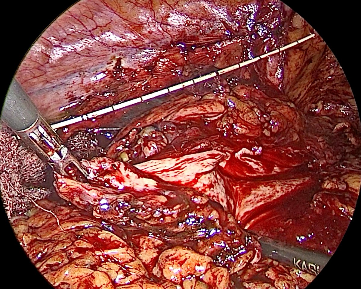 youtu.be/1caD7eJZXnA
Sharing Few Technical points while raising the Boari Flap
1. No detrussor dissection after marking 
2.First incision at the tip of the flap with scissors 
3.flap raised in reverse direction to keep the base of the flap adequate
Suggestions and comments
