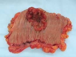 immunooncol's tweet photo. #Cancer is a generic term for a large group of diseases that can affect any part of the body. Other terms used are malignant #tumours and #neoplasms. https://t.co/BpL7L0Uv6o