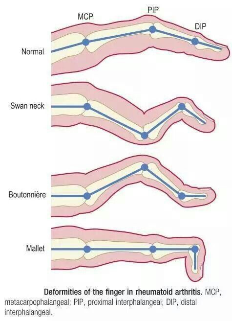 medflutter_'s tweet photo. Deformities in RA! https://t.co/xXg3G2pLXE