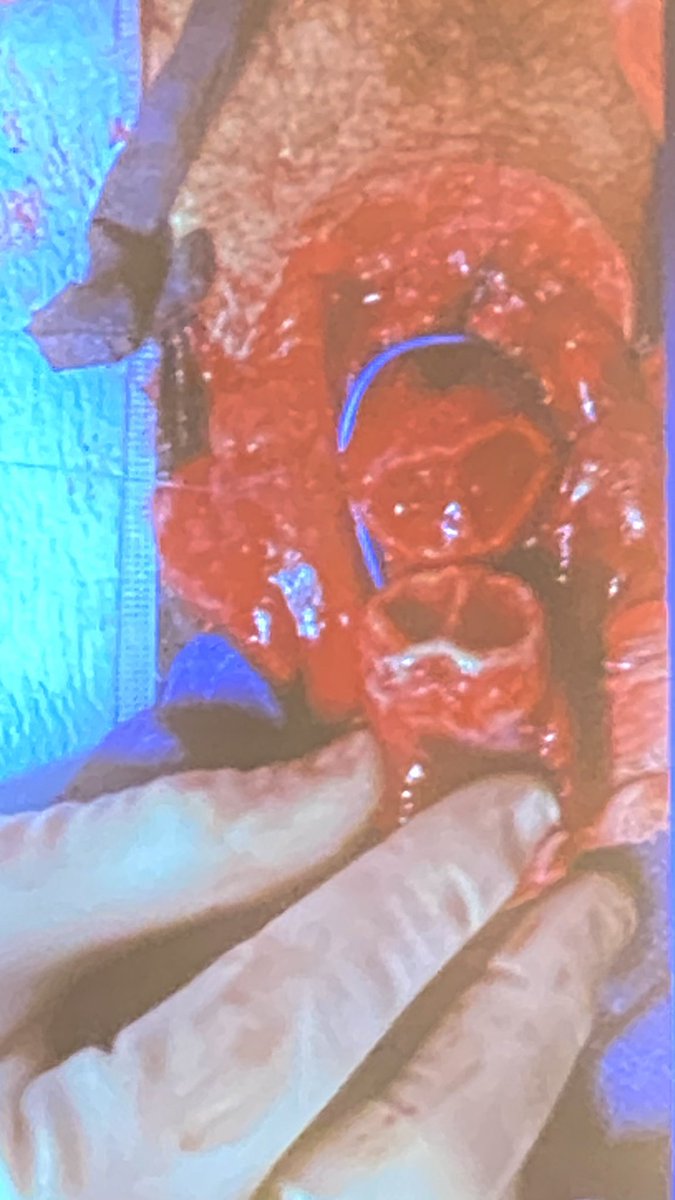 Dr. Benjamin Lee (@benleeurology) on Twitter photo Dr Matt Gretzer presenting on complex reconstructive urologic cases. Amputated phallus can be saved. Dr Twiss President. Dr Tzou Scientific Chair. Arizona Urological Society meeting off to a great start! <a href="/GretzerMatthew/">Matthew Gretzer</a> <a href="/CTwissMD/">Christian Twiss, MD, FACS</a> <a href="/DTzouMD/">David T. Tzou, MD</a> <a href="/AZurological/">Arizona Urological Society</a> Dr Matt Gretzer presenting on complex reconstructive urologic cases. Amputated phallus can be saved. Dr Twiss President. Dr Tzou Scientific Chair. Arizona Urological Society meeting off to a great start! <a href="/GretzerMatthew/">Matthew Gretzer</a> <a href="/CTwissMD/">Christian Twiss, MD, FACS</a> <a href="/DTzouMD/">David T. Tzou, MD</a> <a href="/AZurological/">Arizona Urological Society</a>