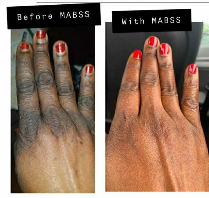 MABSS18's tweet photo. See results for #MABSS knuckle treatment.
#knuckletreatment #skinrepair #notoskinbleaching https://t.co/o9MFD8fcbD