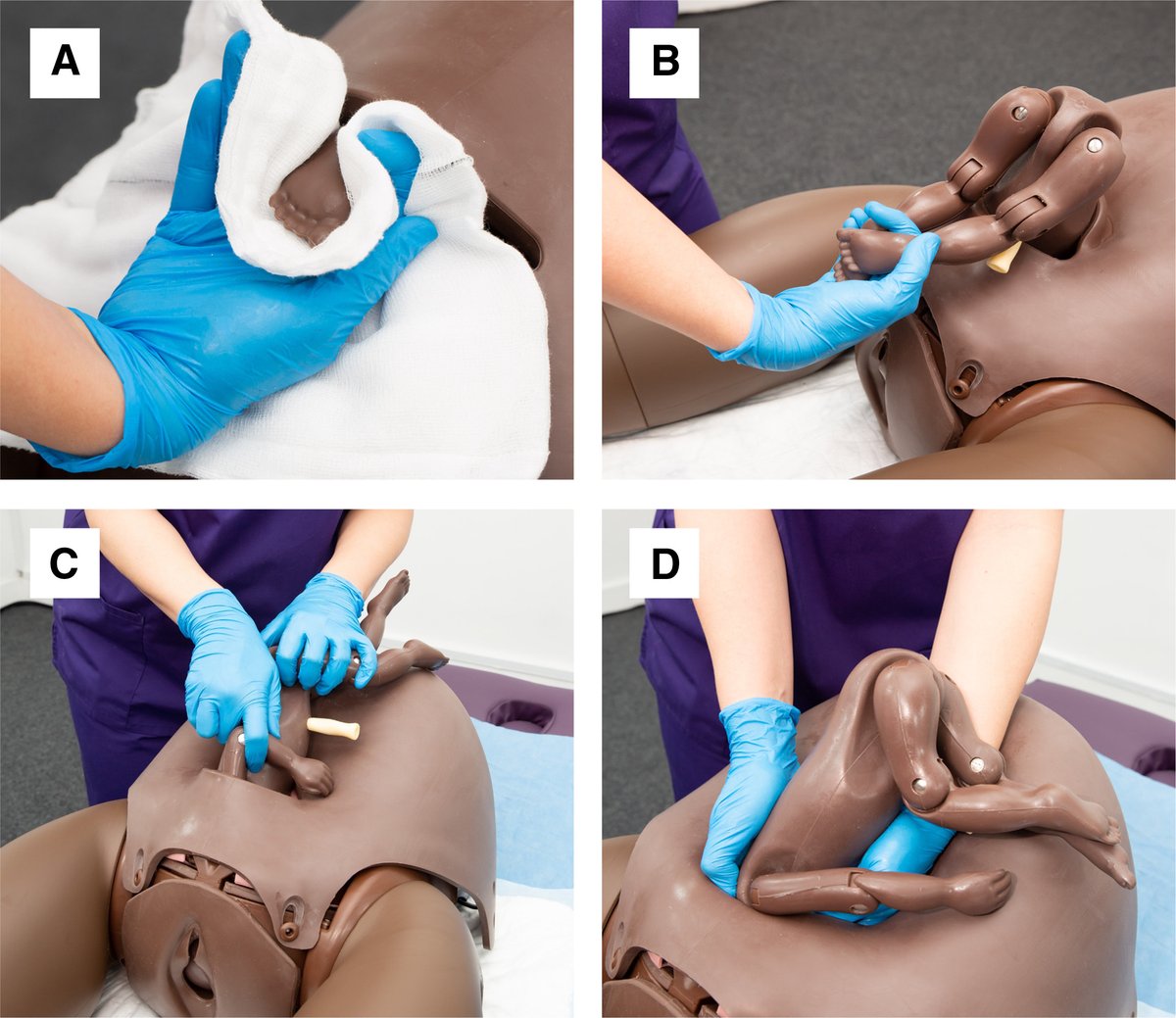 AJOG_thegray's tweet photo. AJOG Expert Review:  Management of impacted fetal head at cesarean delivery - Reverse breech extraction https://t.co/eeeqLRUvdA https://t.co/3iU9smpar8
