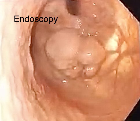 Vermie_G's tweet photo. Gastric GIST
Adjacent to the LES
Easily Movable
Compare size of Endoscope vs.  GIST
What will be your Best Approach ?
Endo- Lap ?
Intragastric Surgery ?
Open Transgastric ?
Lapararoscopic Gastrotomy https://t.co/MbeKmMNp6Z