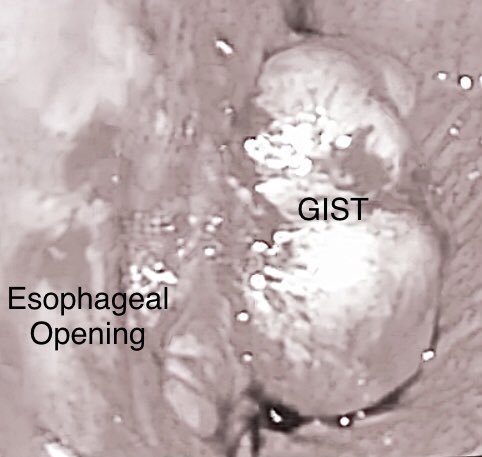 Vermie_G's tweet photo. Gastric GIST
Adjacent to the LES
Easily Movable
Compare size of Endoscope vs.  GIST
What will be your Best Approach ?
Endo- Lap ?
Intragastric Surgery ?
Open Transgastric ?
Lapararoscopic Gastrotomy https://t.co/MbeKmMNp6Z
