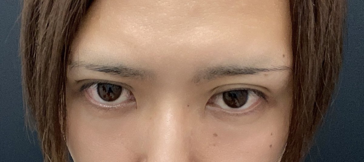 BBcute1006's tweet photo. いつかやるぞから約7年
埋没で二重にした
これでもう目つきが悪いとは言われない https://t.co/Q47H14bIOz