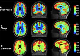 This is your brain on sleep deprivation. Scientists in Canada launched the largest study on how lack of sleep affects the brain. They created games that tested skills like reasoning, language comprehension & decision making. They had one participant repeat these tests in an…