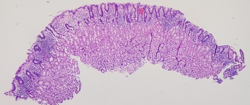 GIJamesMD's tweet photo. Classic #GIpath pattern of injury.
#PathMatch23 #PathMatch24, what is the diagnosis on 4x until proven otherwise? https://t.co/35921M76ZM