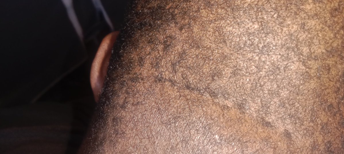 LeeLinduyise's tweet photo. @MDIMA64526158 @SkindoctorsSA @Herbalife @akreana_ @drbusani1 Damatol helped me brother. Thank you https://t.co/ap7TSTuTtp