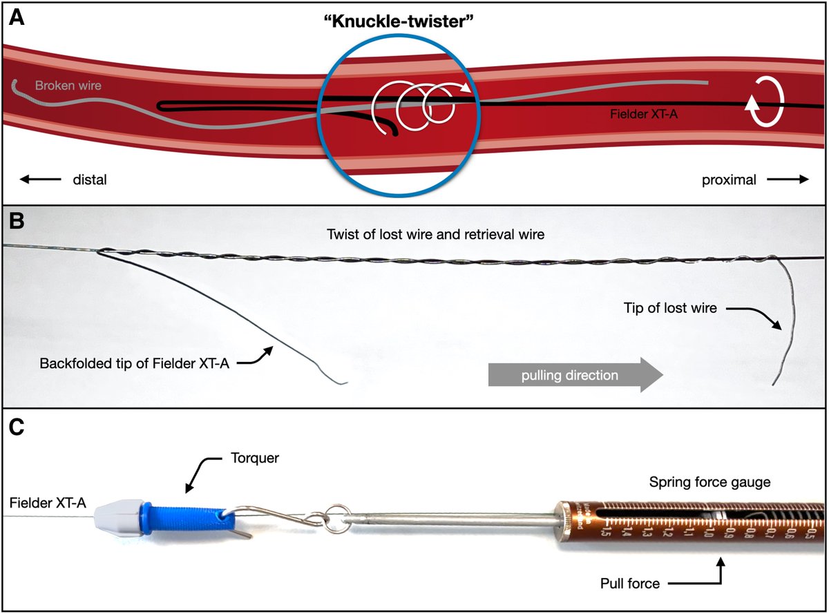 Came across this interesting technique of guidewire fragment retrieval by @swissCTO, @AlexAchimMD, @LKrivoshei published in @ESC_Journals Case Reports - pubmed.ncbi.nlm.nih.gov/37539349/. Thoughts from CHIP/CTO operators? Very intriguing and remarkably simplistic.