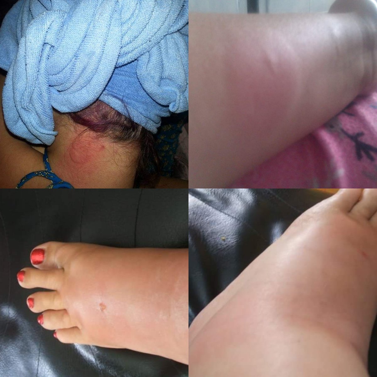 kittylulabelle's tweet photo. @FayeEsq @drlouisenewson I tried Tegaderm,various types of sticking plaster both pre cut and on a roll and then kinesio tape but couldn't get anything to stick more than 4/going on 5 days at absolute max and with extra shower precautions too. My skin is both ridiculously soft and also reactive AF 🫣 https://t.co/Pwi32SpuUA