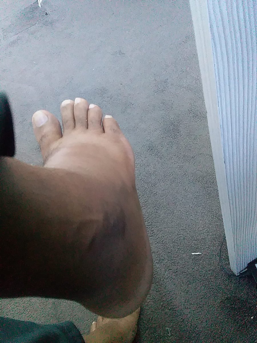 Hi Guys, my bro is suffering from Arthritis as you can see in the picture below his ankle has been swollen. <a href="/LukeCoutinho17/">Luke Coutinho</a> <a href="/hubermanlab/">Andrew D. Huberman, Ph.D.</a> I will be grateful if I get proper advice.