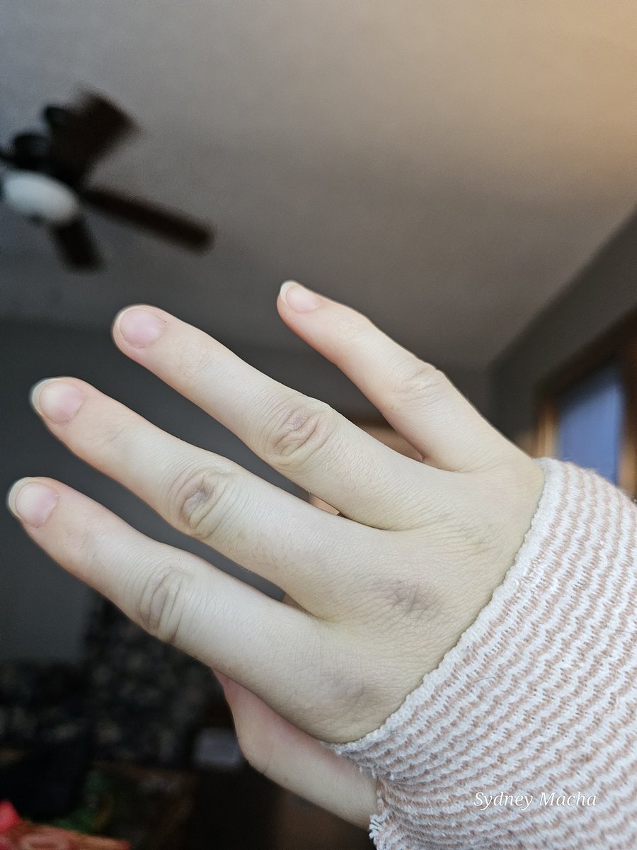 My hand is turning green from the bruising after my surgery