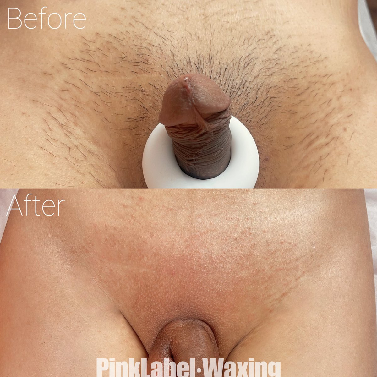 为什么只剩一颗牙，吃饭还塞牙？
因为吃藕，套藕眼儿里了🤷🏼

#热蜡除毛 #热蜡脱毛 #脱毛 #北京脱毛 #O娘