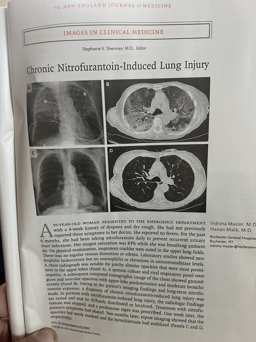 phlegmfighter's tweet photo. The last case of #macrobid #pulmonary #toxicity I saw was also upper lobe predominant; it had been missed in 5 consecutive healthcare encounters for CC #dyspnea because nobody bothered to get an accurate #medication #history. #bronch narrowly averted. 3 unnecessary #ABx courses. https://t.co/K5dtSbtYH2