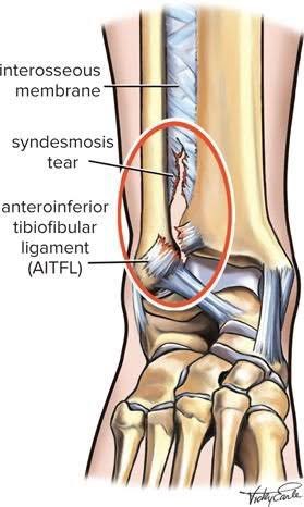 InjuryExplained's tweet photo. Nathan Murphy’s left ankle injury suggestive of minor syndesmosis as his foot twists after getting trapped. High ankle sprains generally take double the time than the more common lateral ankle sprains and he could need 4-6 weeks of recovery and rehab.
#afl
#AFLHawksPies https://t.co/6ggks4bogM