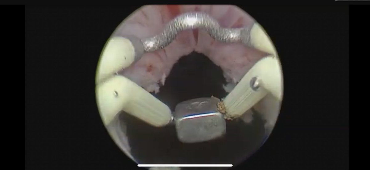 In Small prostates: 
#AEEP #TURP #Vaprorization or anything else you do = bladder neck mucosa preservation between 10h and 2h is the way to avoid sclerosis 😎😎😎😎😎