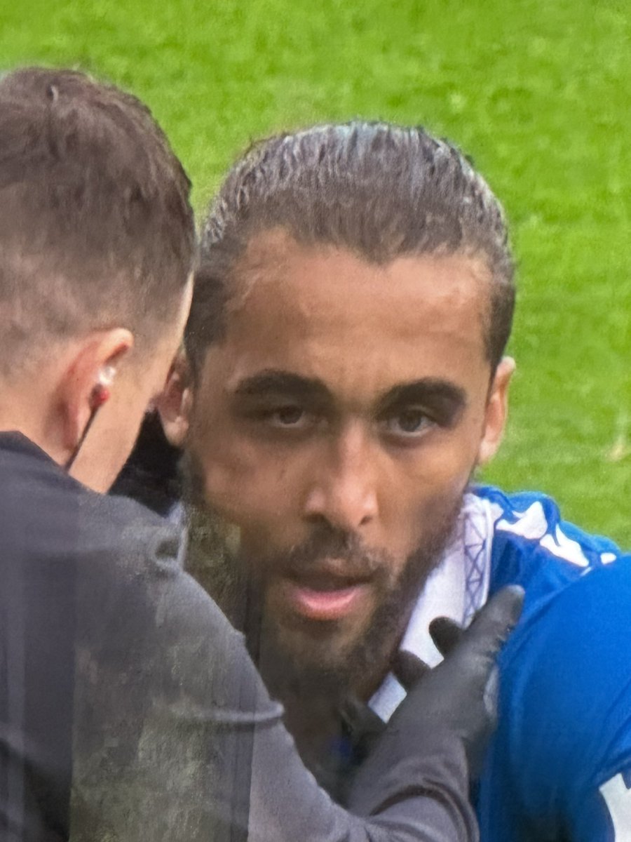 shocking how the medical staff let Calvert Lewin play on😂😂😂