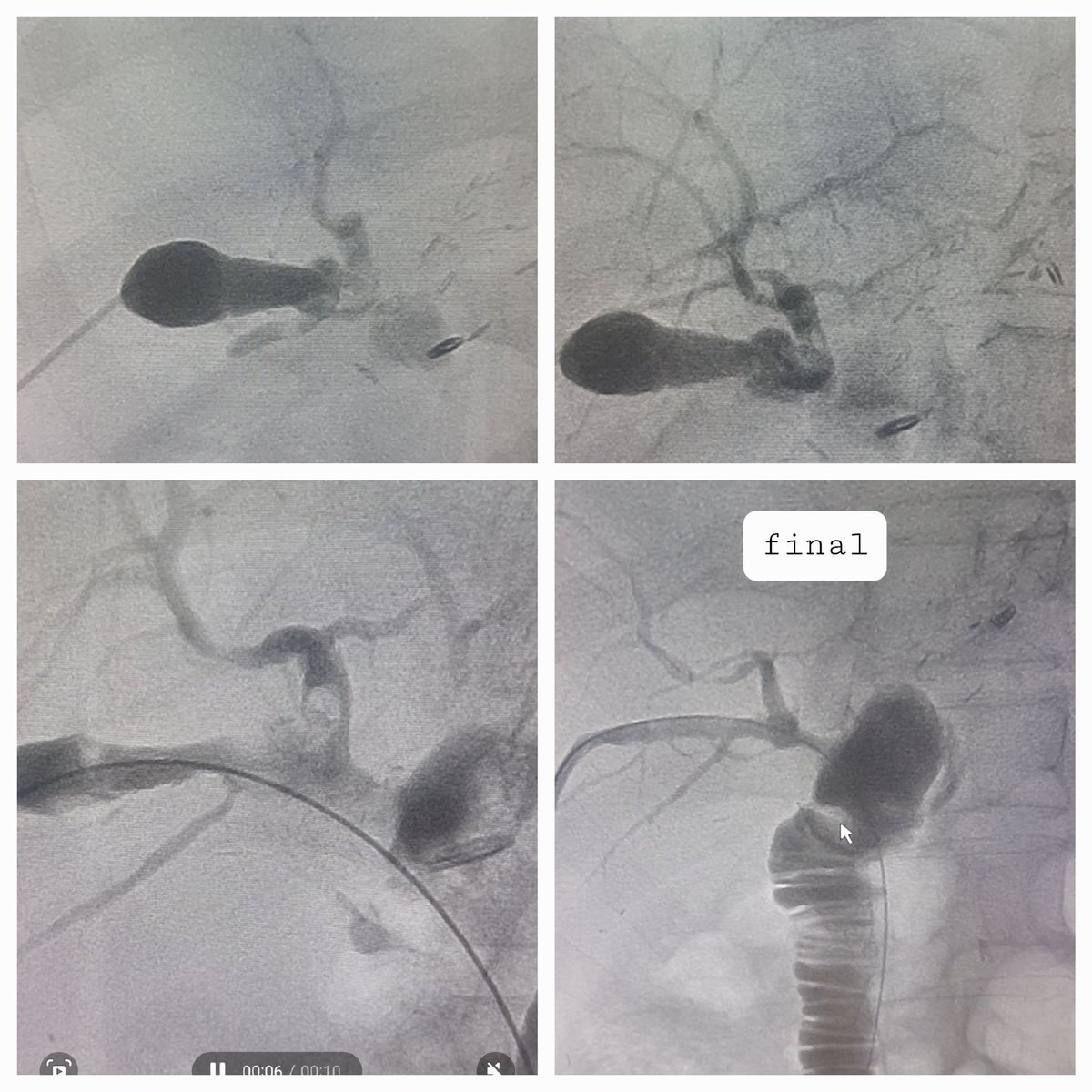 Dr Saurabh kumar Interventional radiologist tweet media