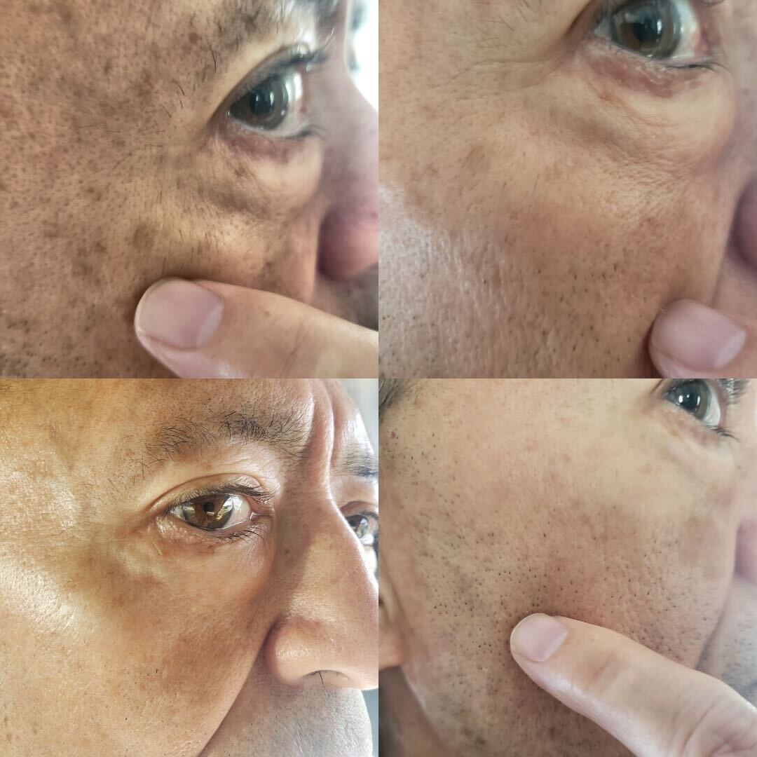 StopGuessingSC's tweet image. PROS: It faded my blotches. CONS: I had to use it everyday for it to work - Kai

BioFormula Select Review - Stop Guessing Dark Spot Removal

#DarkSpotRemoval #ClearComplexion #SkincareEssentials  #bioformulaselect #stopguessingskincare #darkspottreatment #bioformulaselectreview