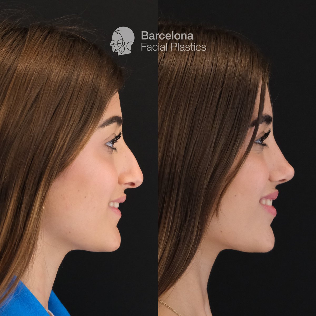Barcelona Facial Plastics tweet media