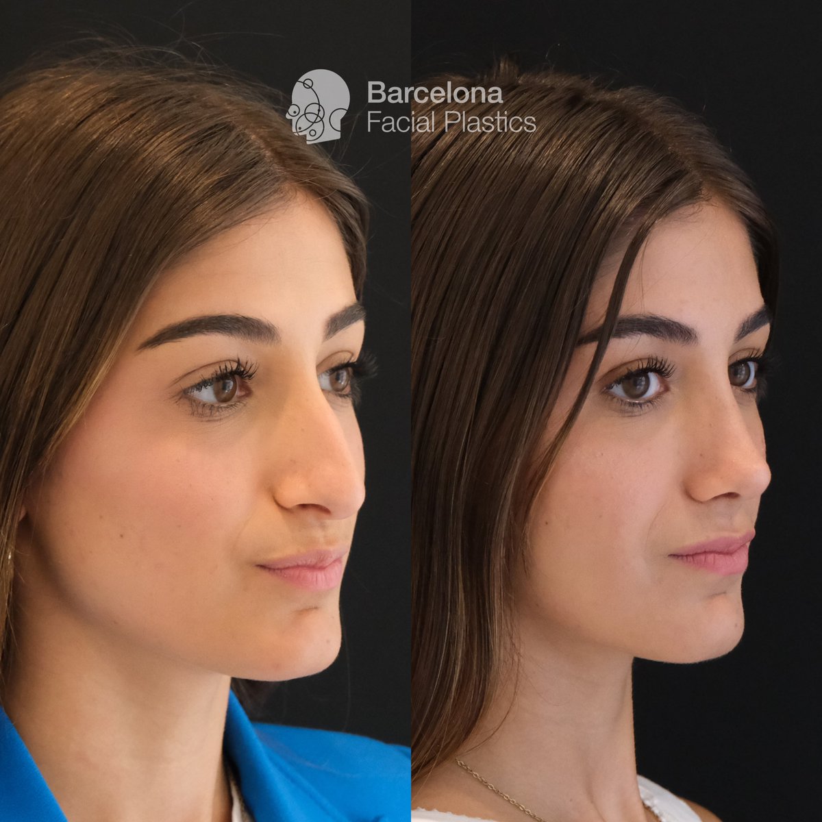 Barcelona Facial Plastics tweet media