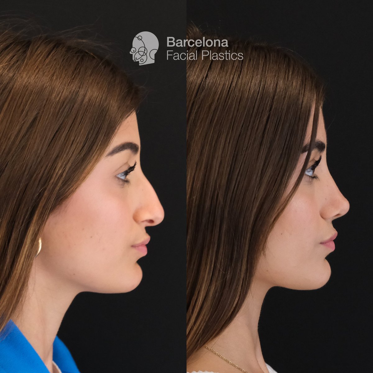 Barcelona Facial Plastics tweet media