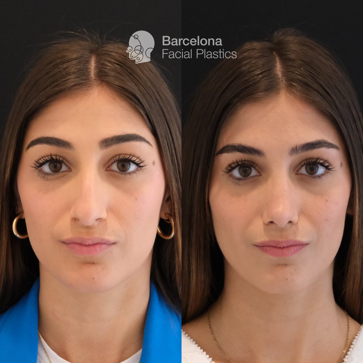 Barcelona Facial Plastics tweet media