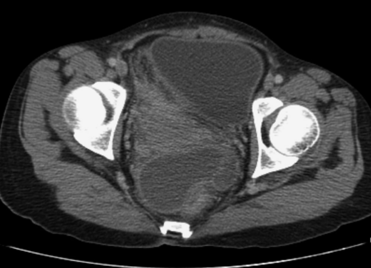 Happy Friday! Ready for another tweetorial??

A 54-Year-Old Female underwent hemicolectomy for colon cancer. Six days following surgery, she presents with fevers and leukocytosis. A CT scan was done.