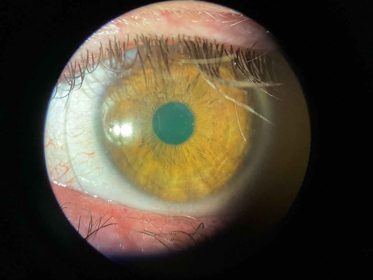 This is a photograph of an eye fit with a custom designed scleral lens. The patient suffered a rare disease known as Stevens Johnson Syndrome, which resulted in numerous eye surgeries and subsequently, poor vision. The patient’s vision improved from 20/70 to 20/20