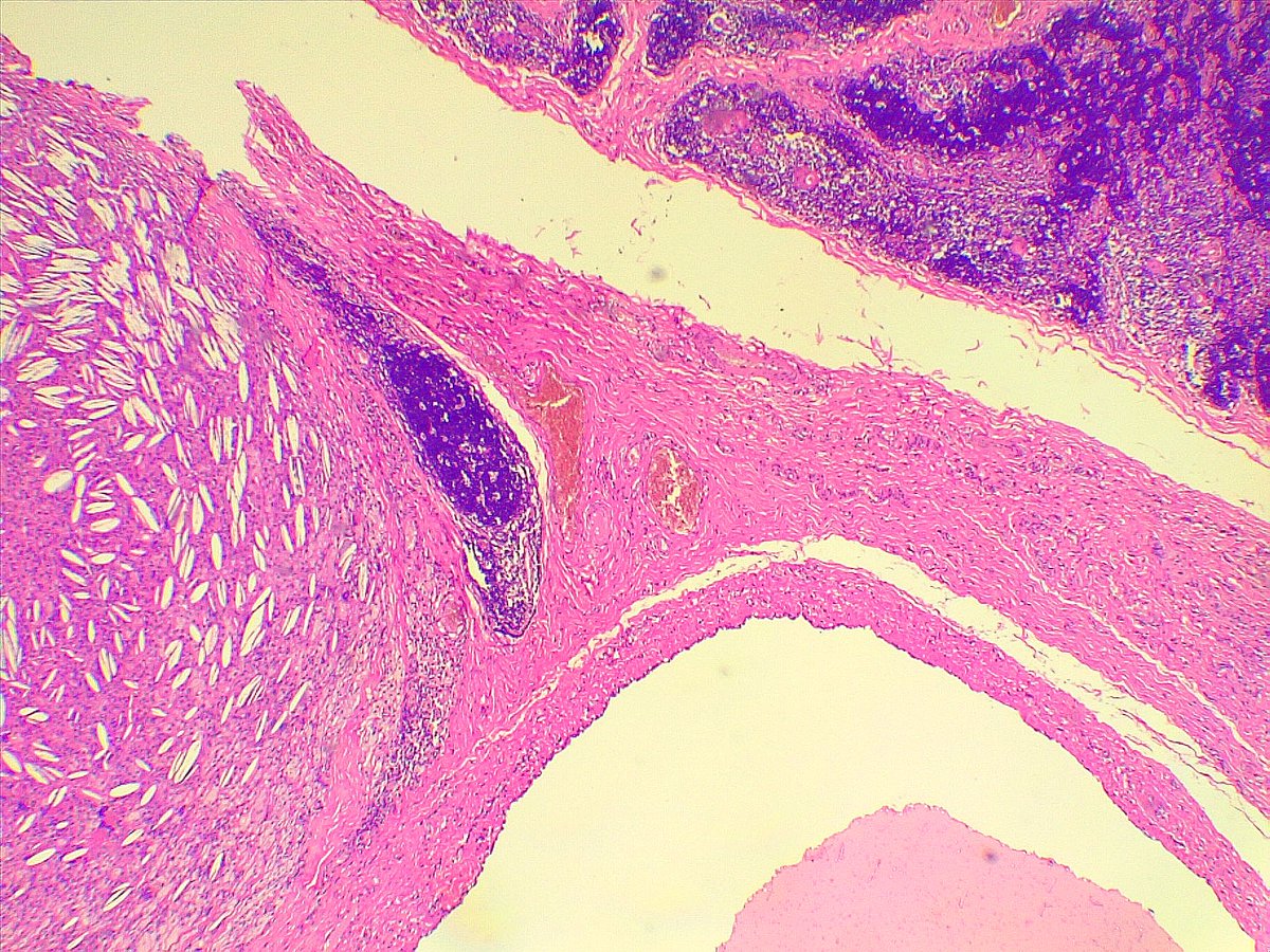 Another thymic related lesion 9 years old boy with large cytic cervical mass extending from submandibular region to lower neck Cervical thymic cyst #PathTwitter