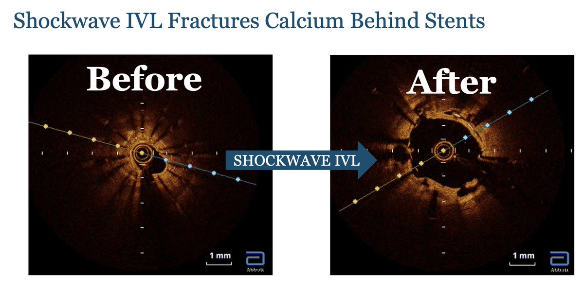 Awesome Case of Shockwave Coronary IVL and OCT for Stent Regret and In-Stent Restenosis 1/