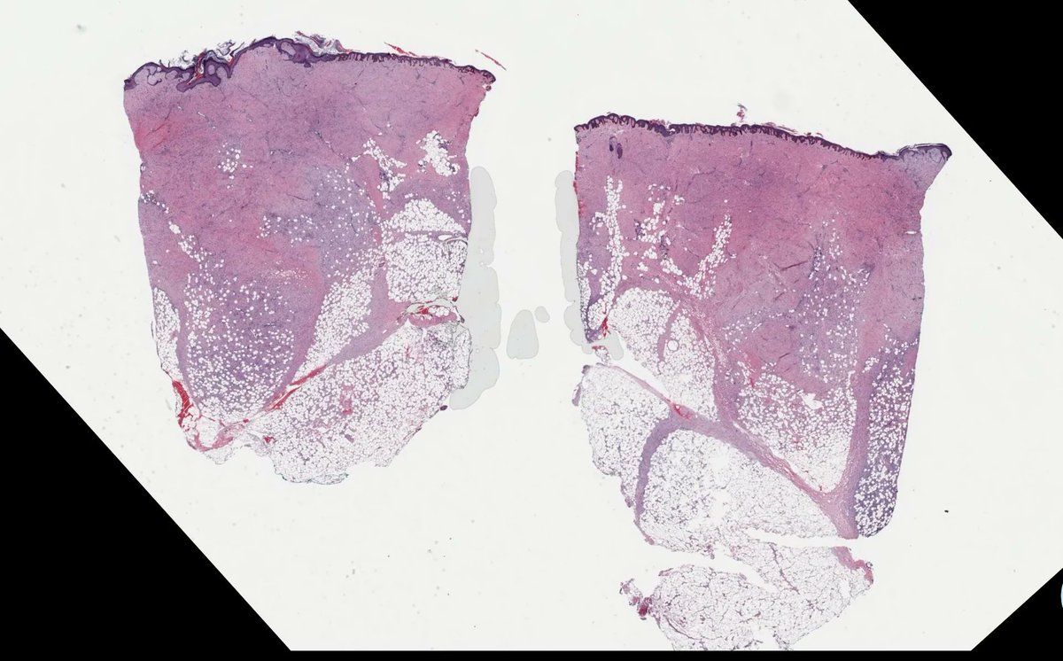 Flank nodule present for yrs. Clinical diagnosis: cyst. Your diagnosis? Answer &amp; video: buff.ly/3dFvhC1. Digital slide via <a href="/pathpresenter/">pathpresenter.com</a>: pathpresenter.net/public/display…. <a href="/mydermpath/">Raj Singh MD</a> #pathology #pathologists #pathTwitter #dermpath #dermatology #dermatologia #dermtwitter