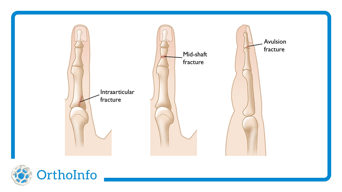 AAOS1's tweet photo. The @Rockies will be without @KrisBryant_23 a little longer as Bryant continues to recover from a #fingerfracture. Although the finger bones are small, a broken finger is not a minor injury. Learn why at #OrthoInfo: https://t.co/afYx8DgyJ1 #Orthotwitter @HandSociety @MLB https://t.co/1ObfX3xkbm