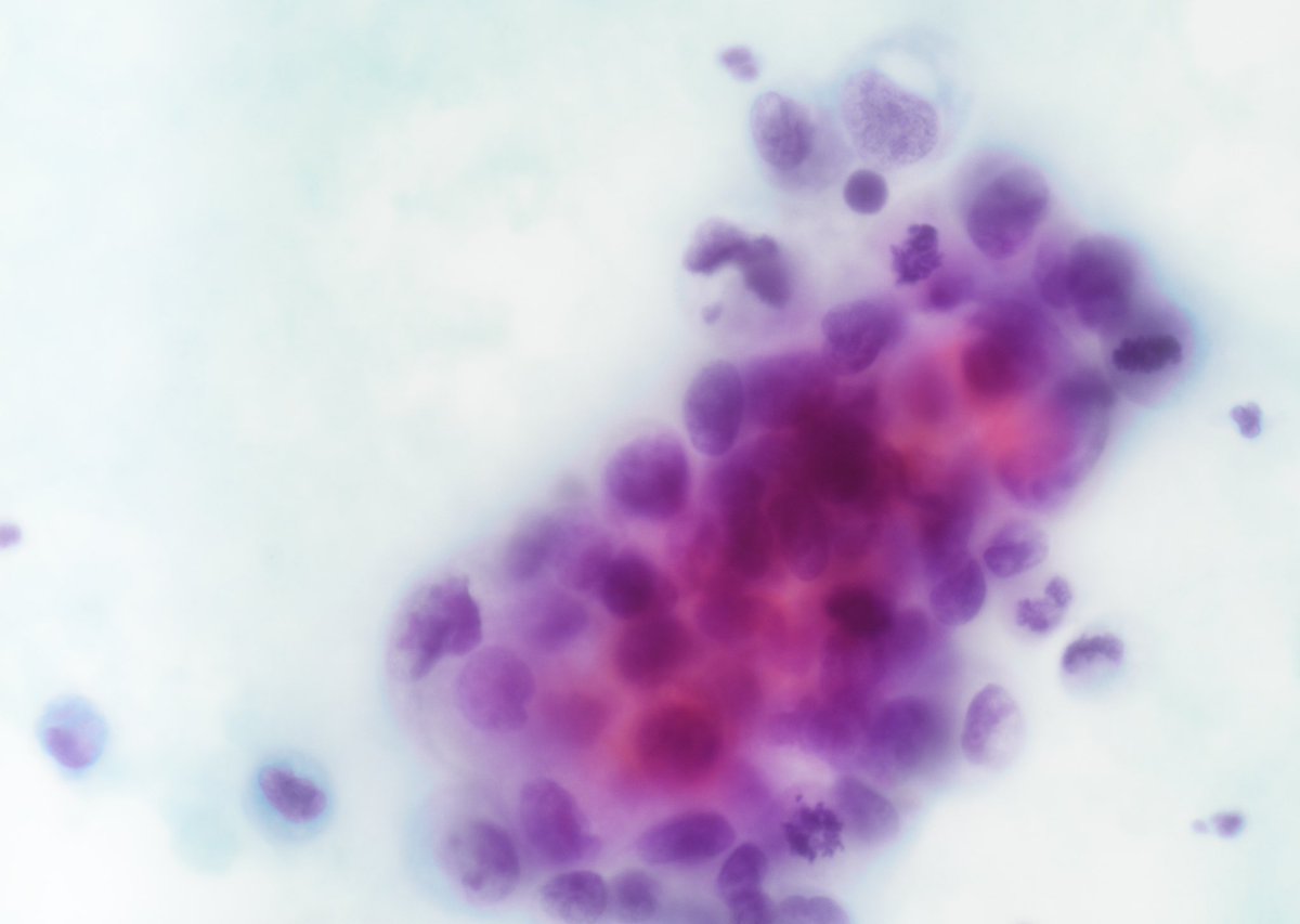 Pleural effusion with neoplastic cells- some even look “signet ring”. 

History of gastric adenocarcinoma with signet ring cell features. #PathTwitter #surgicalpath #cytology #oncology #pathology