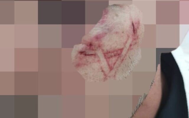 m7mdkurd's tweet image. Israeli Occupation Forces have branded a Star of David on the face of a young Palestinian man they arrested in the Shufat Refugee Camp. All body cameras belonging to the 16 officers involved in the arrest were turned off. #zionism