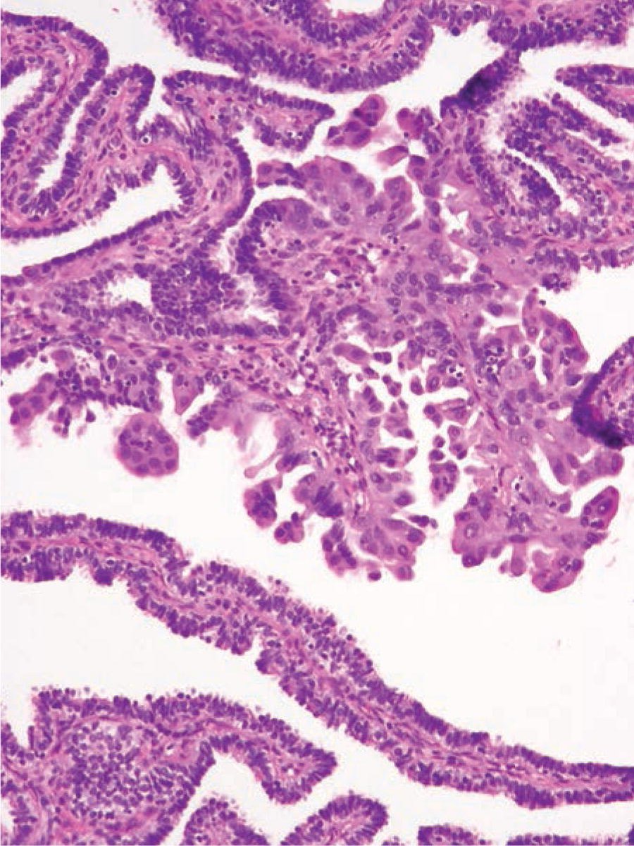More from the ovary fascicle!
Metaplastic papillary tumor is typically discovered incidentally in the fallopian tubes of pregnant/postpartum patients, and closely resembles (and may represent) a serous borderline tumor. All reported cases have been benign. #GynPath
