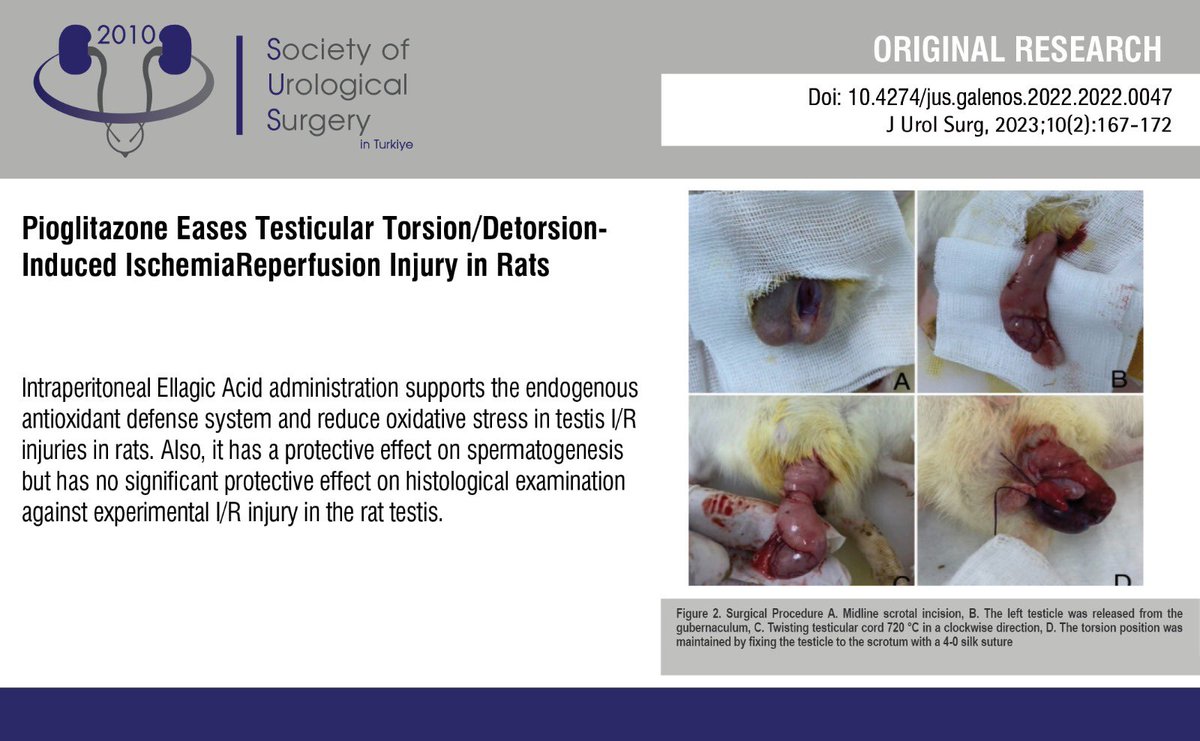 Pioglitazone Eases Testicular Torsion/Detorsion-Induced IschemiaReperfusion Injury in Rats
 
You can see the free full text of the research by İrfan Yıldırım Şentürk et al.
 
Link : cms.jurolsurgery.org/Uploads/Articl…
 
#Testicular #torsion #ischemia #reperfusion