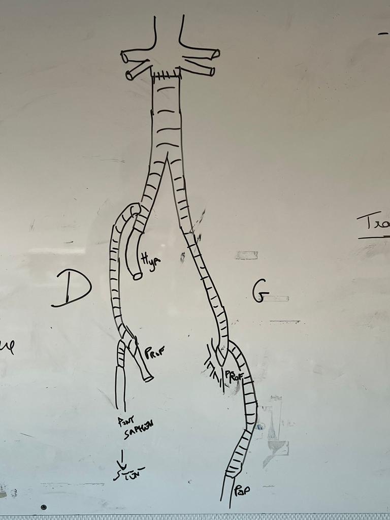 7 infected aortas in 12 days. Top highlight, duodenal-aorto-bifem graft fistula w/ L fem pop infection. Long surgery, re-re-re-redo groins. once duodenum repaired, unclamp first towards R hypo and while doing R fem anast, L popliteal perfused by Pruitt from left limb #aortaEd