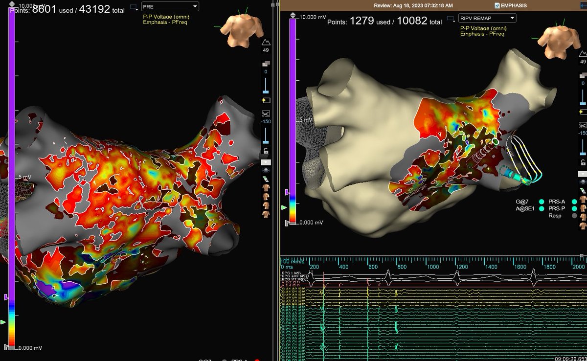 DaleYooMD's tweet photo. #OTNearField To the rescue! Easily touching up the veins on a redo AF patient with the help of the #EmphasisMaps. One targeted burn and the vein isolated!
#HDGrid #ZeroFluoro #Voxel #EPeeps https://t.co/YHXUkOJhnL