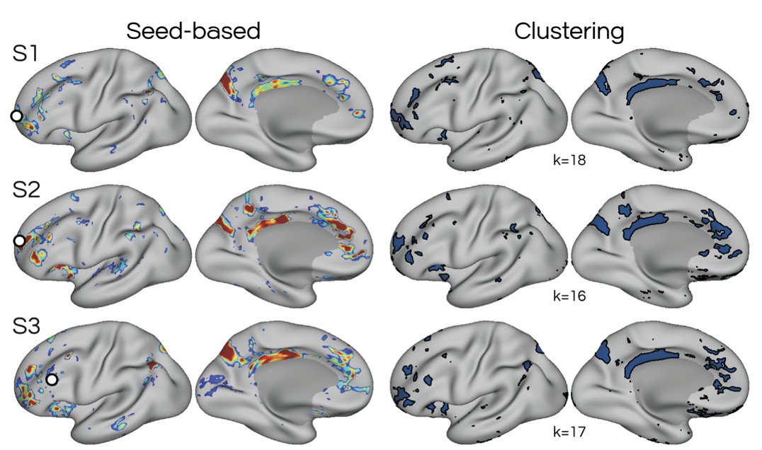 Rodrigo Braga (@rodbraga) on Twitter photo New (and first!) preprint from the Braga Lab!
biorxiv.org/content/10.110…
<a href="/judy_yhkwon/">YoungHye Judy Kwon</a> investigated the parietal memory network (PMN) in densely sampled participants using high-res 7T fMRI.
We saw smaller regions of the PMN that are inconsistently reported, esp. in group maps. New (and first!) preprint from the Braga Lab!
biorxiv.org/content/10.110…
<a href="/judy_yhkwon/">YoungHye Judy Kwon</a> investigated the parietal memory network (PMN) in densely sampled participants using high-res 7T fMRI.
We saw smaller regions of the PMN that are inconsistently reported, esp. in group maps.
