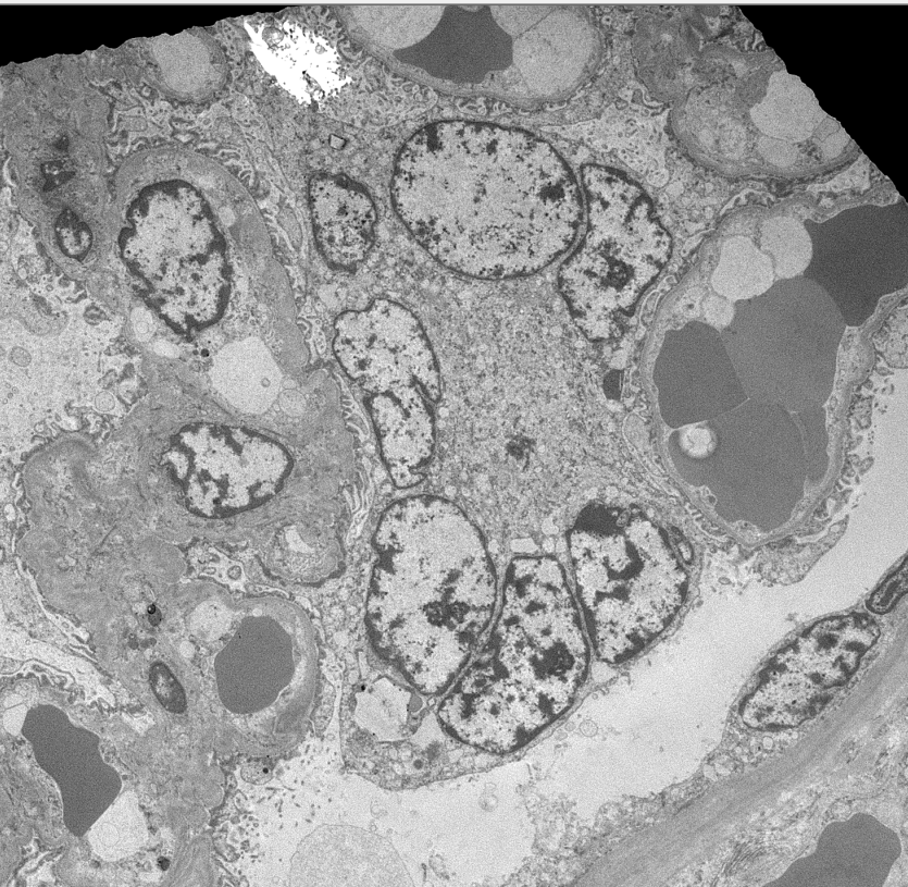 JZRenalPath's tweet photo. Striking example of multinucleated podocytes in a case of cystinosis. EM shows crystalline clefts in podocyte cytoplasm. #renalpath #pathtwitter https://t.co/5Duh34fqda