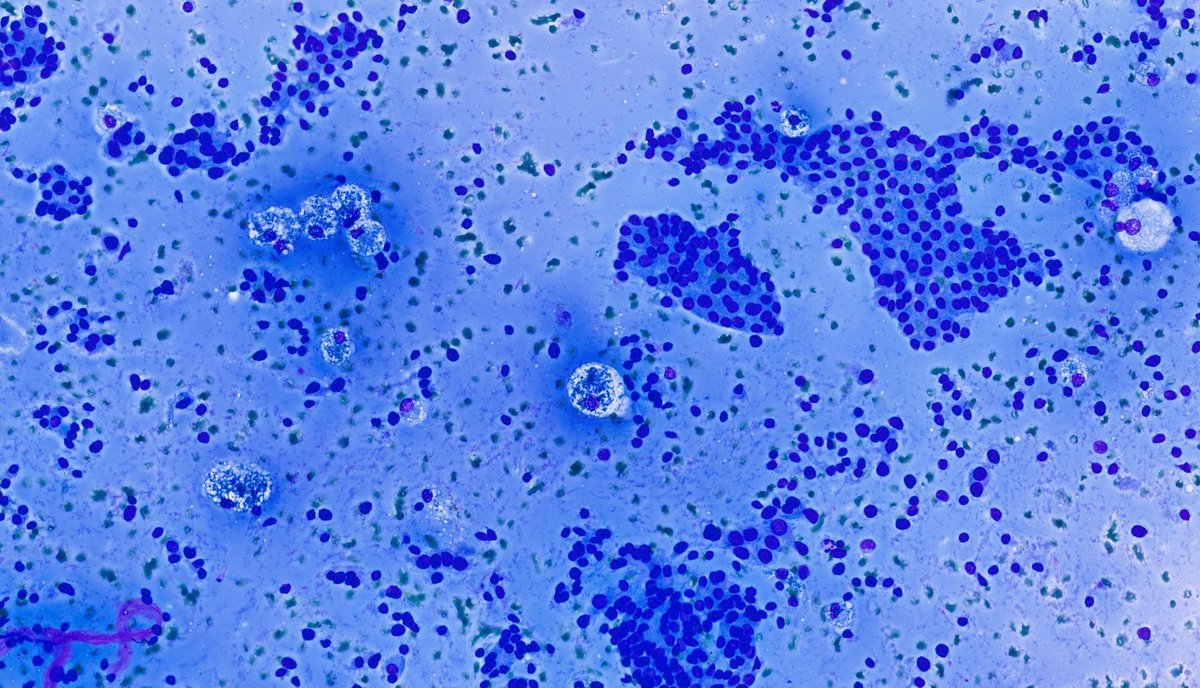 WillyFogPath's tweet image. Sabías que... los patólogos utilizan el Sistema Bethesda para el diagnóstico citológico por punción de lesiones de tiroides🦋
Nueva versión 2023.
🔹️I insuficiente
🔹️II benigno
🔹️III atípico
🔹️IV neoplasia folicular
🔹️V sospechoso
🔹️VI maligno
#CytoPath #EndoPath #PAAF