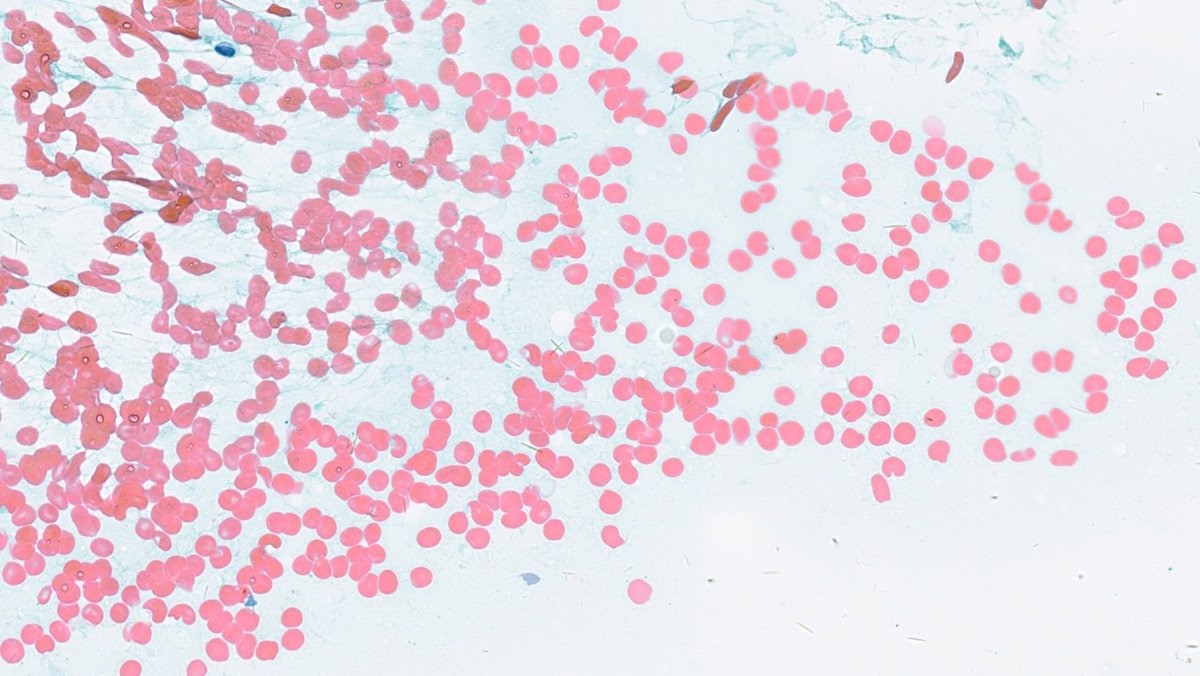WillyFogPath's tweet image. Sabías que... los patólogos utilizan el Sistema Bethesda para el diagnóstico citológico por punción de lesiones de tiroides🦋
Nueva versión 2023.
🔹️I insuficiente
🔹️II benigno
🔹️III atípico
🔹️IV neoplasia folicular
🔹️V sospechoso
🔹️VI maligno
#CytoPath #EndoPath #PAAF